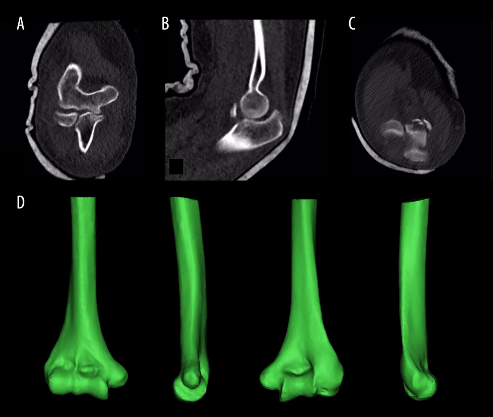 CT scans and 3D reconstruction of the humerus. (A–C) Preoperative CT scans: Anteroposterior (A), sagittal (B), and transverse (C) CT images of the elbow joint, which were used for reconstruction of the 3D model. (D) 3D Reconstruction: 3D reconstruction images of the humeral portion based on the CT scan data using Mimics Medical 16.0 software (Materialise, Belgium). The 3D model was used to design the pin guide template.