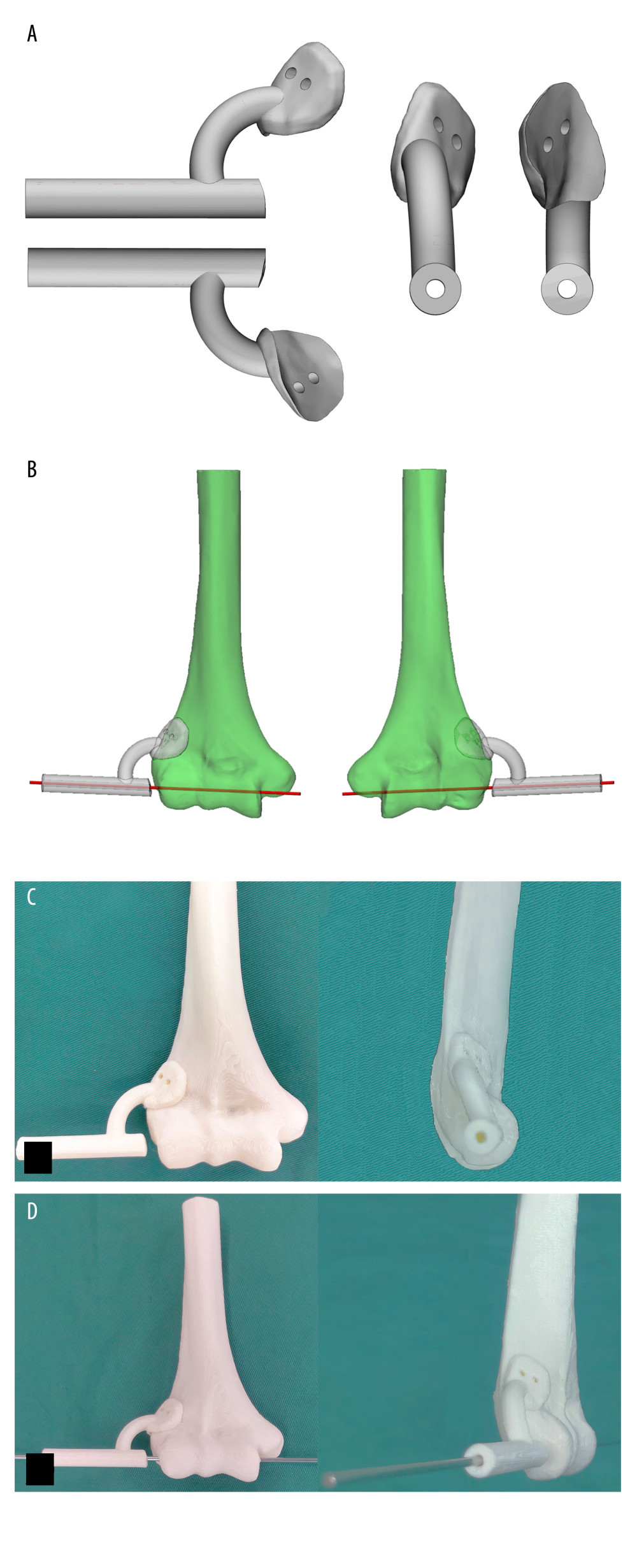 Design of the guide template based on 3D reconstruction. (A, B) Guide template design: Digital design of the pin guide template based on the 3D reconstruction of the humeral portion. The template was created using 3-matic 12.0 (Materialise, Belgium), ensuring it fit accurately onto the lateral condyle of the humerus. The final design of the guide template is shown, demonstrating its intended placement for pin insertion along the flexion-extension axis of the elbow joint. (C) The physical model of the distal humerus and the pin guide template were rapidly prototyped using polymer photosensitive resin via a 3D printer (Dreamer, Flsaforge, Zhejiang, China). The guide template is placed on the lateral condyle of the humerus to demonstrate its fit. (D) Inserting the guide pin through the well-designed channel to confirm whether the position is satisfactory.
