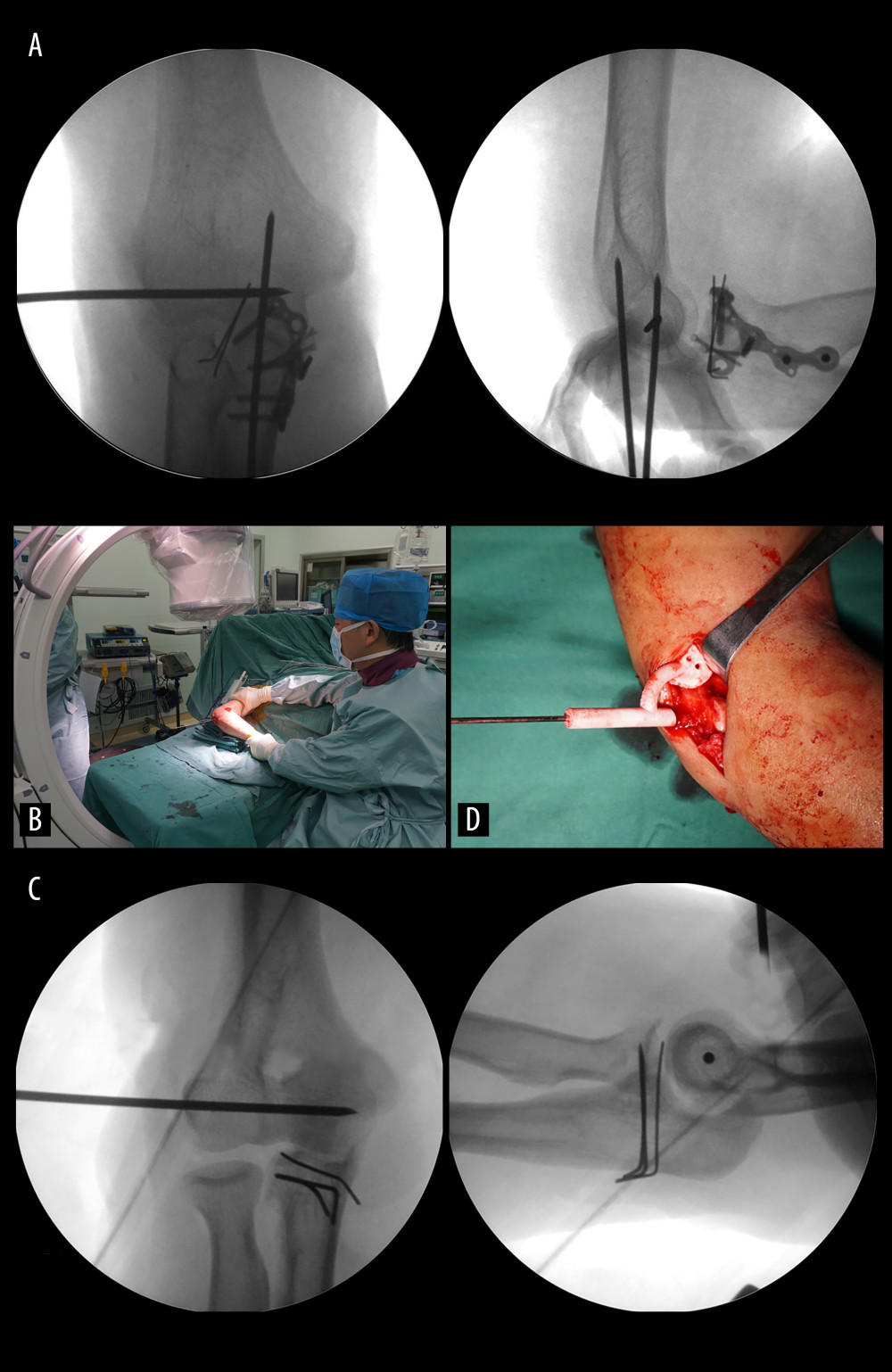 Comparison of guide pin placement between the free-hand group and the guide plate group in surgeries. (A) Intraoperative anteroposterior and lateral fluoroscopic images of the elbow joint are used to confirm the position of guide pin in free-hand group. (B) The guide pin is placed under the fluoroscopy of the C-arm during the operation in free-hand group. (C) Intraoperative anteroposterior and lateral fluoroscopic images of the elbow joint are used to confirm the position of guide pin in guide template group. (D) The guide pin is placed under the fluoroscopy of the C-arm during the operation in guide template group.