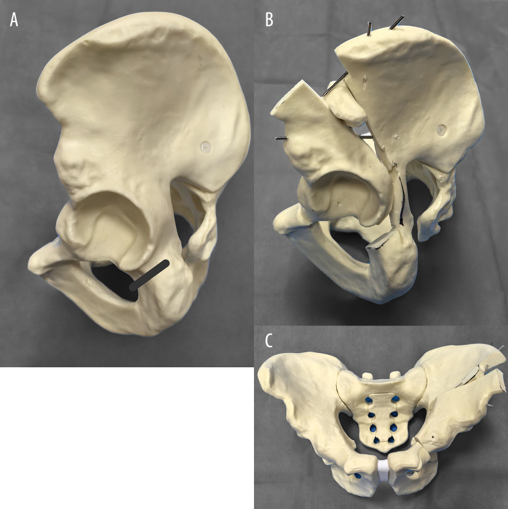 Surgical procedure of periacetabular osteotomy (PAO) demonstrating key osteotomy steps in lateral decubitus and supine positions (Neusoft Medical image diagnostic reporting system; Neusoft Co Ltd, Shenyang, China). (A) The lateral decubitus position: the osteotome was used to truncate the anterior half of the ischium along the direction of the inferior acetabular groove. (B) The supine position: the pubic double tip bone chipper, quadrilateral, ilium, and periacetabular osteotomy were performed to connect with the ischium osteotomy. The iliac bone block was inserted into the osteotomy gap. The anterior superior iliac spine was reduced and fixed with cortical bone screws. (C) Anteroposterior schematic view of the pelvis.