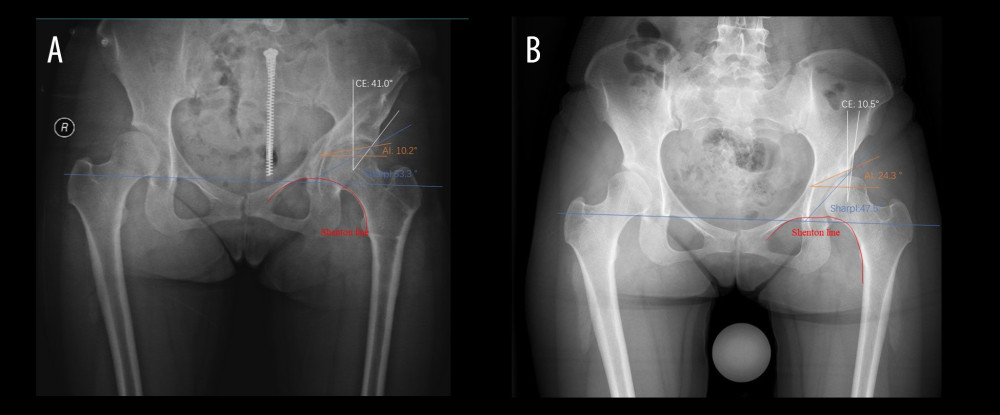 Pre- and postoperative radiographic evaluation demonstrating improvement in acetabular coverage and joint congruency following periacetabular osteotomy (PAO) (Neusoft Medical image diagnostic reporting system; Neusoft Co Ltd, Shenyang, China). (A) Preoperative imaging of a 24-year-old female patient with developmental dysplasia of the left hip. The left center-edge angle, acetabular index (AI), and Sharp angle are 10.5°, 24.3°, and 47.5°, respectively, with a disrupted Shenton line. (B) Imaging at 53 months postoperatively following PAO shows improved measurements: the CE angle is 41.0°, AI is 10.2°, and Sharp angle is 33.3°, with a restored and continuous Shenton line.