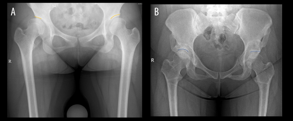 Preoperative and postoperative comparison of acetabular sourcil length demonstrating improved acetabular coverage after periacetabular osteotomy (PAO) (Neusoft Medical image diagnostic reporting system; Neusoft Co Ltd, Shenyang, China). Preoperative (A) and postoperative (B) acetabular sourcil length in a 28-year-old female patient with bilateral developmental dysplasia of the hip. The sourcil length increased from 25.16 mm preoperatively to 32.77 mm at 37 months postoperatively in the left hip and from 28.17 mm to 28.84 mm in the right hip, indicating improved acetabular coverage following periacetabular osteotomy.