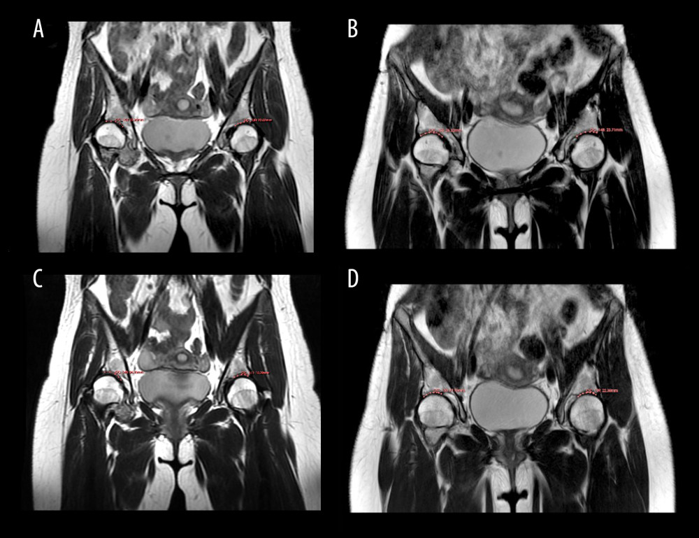 Magnetic resonance imaging (MRI) shows increased acetabular cartilage width in the weight-bearing region following periacetabular osteotomy (PAO): representative cases with bilateral developmental dysplasia of the hip (DDH) (Neusoft Medical image diagnostic reporting system; Neusoft Co Ltd, Shenyang, China). MRI of 2 patients with bilateral developmental dysplasia of the hip show pre- and postoperative changes in acetabular cartilage width. Patient 1: a 25-year-old woman. (A) Preoperatively, the cartilage width in the acetabular weight-bearing area was 20.82 mm in the left hip and 23.24 mm in the right hip. (B) At the 37-month follow-up, the cartilage width increased to 23.71 mm in the left hip and 26.32 mm in the right hip. Patient 2: a 28-year-old woman. (C) Preoperatively, the cartilage width was 18.29 mm in the left hip and 21.66 mm in the right hip. (D) At the 41-month follow-up, the cartilage width increased to 21.90 mm in the left hip and 24.33 mm in the right hip.