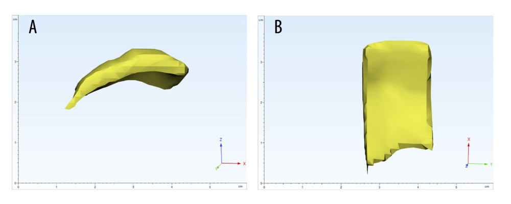 Three-dimensional MRI reconstruction illustrating the cartilage area within the acetabular weight-bearing zone (region of interest) after periacetabular osteotomy (PAO) in a patient with developmental dysplasia of the hip (DDH) (Mimics 16.0; Materialise, Leuven, Belgium). Following periacetabular osteotomy of the right hip joint in a patient with developmental dysplasia of the hip, we identified the region of interest for measurement as the cartilage area within the acetabular weight-bearing zone, determined through 3-dimensional MRI reconstruction. (A) Anterior view. (B) Interior view.