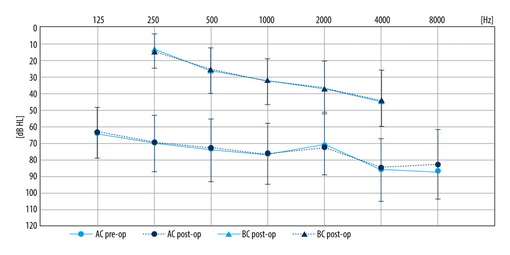 Mean preoperative (grey solid line) and postoperative (dotted line) thresholds. Whiskers indicate standard deviations. Software for figure creation: Microsoft Office LTSC Professional Plus 2021 EXCEL ver. 2108.