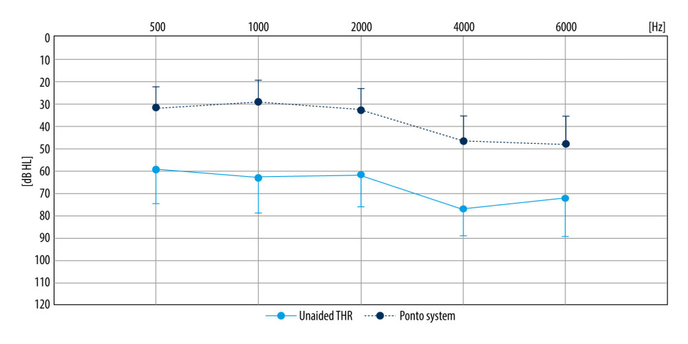 Free-field thresholds before and after operation: mean preoperative unaided (grey solid line) and postoperative with the Ponto system (dotted line). Whiskers indicate standard deviations. Software for figure creation: Microsoft Office LTSC Professional Plus 2021 EXCEL ver. 2108.