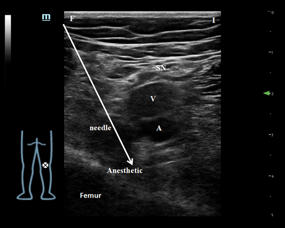 Ultrasound images demonstrating IPACK. SN – sciatic nerve; A – popliteal artery; V – popliteal vein. Arrows indicate the needle. F – distal left lower limb; I – inner thigh. Arrows indicate the needle; Anesthetic stands for injection target; ⊗ – ultrasonic probe placement position.