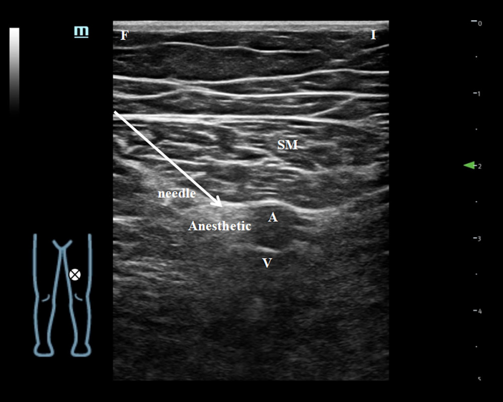 Ultrasound images demonstrating ACB. F – distal left lower limb; I – inner thigh; SM – sartorius; A – femoral artery; V – venae femoris. arrows indicate the needle. Anesthetic stands for injection target. ⊗ – ultrasonic probe placement position.