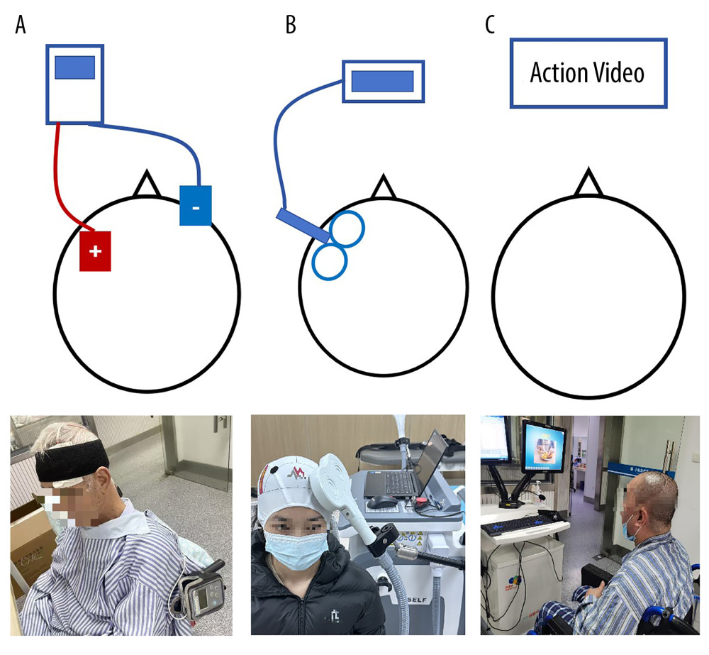 Schematic illustration of neuromodulation techniques applied in aphasia rehabilitation (WPS Office, 12.2.0, Kingsoft Office Software Corporation Limited). This figure illustrates the application of 3 neuromodulation techniques in aphasia rehabilitation: (A) Transcranial direct current stimulation (tDCS) – delivering low-intensity electrical current via scalp electrodes to modulate cortical excitability, typically enhancing left hemisphere language areas or inhibiting right hemisphere homologs; (B) Transcranial magnetic stimulation (TMS) – applying repetitive magnetic pulses to stimulate or inhibit targeted cortical regions (eg, Broca’s area), using low-frequency (inhibitory) or high-frequency (excitatory) protocols; (C) Mirror neuron system (MNS) therapy – engaging language-related sensorimotor circuits through action observation and imitation tasks, aiming to enhance speech and communication functions behaviorally. tDCS – transcranial direct current stimulation; TMS – transcranial magnetic stimulation; MNS – mirror neuron system.
