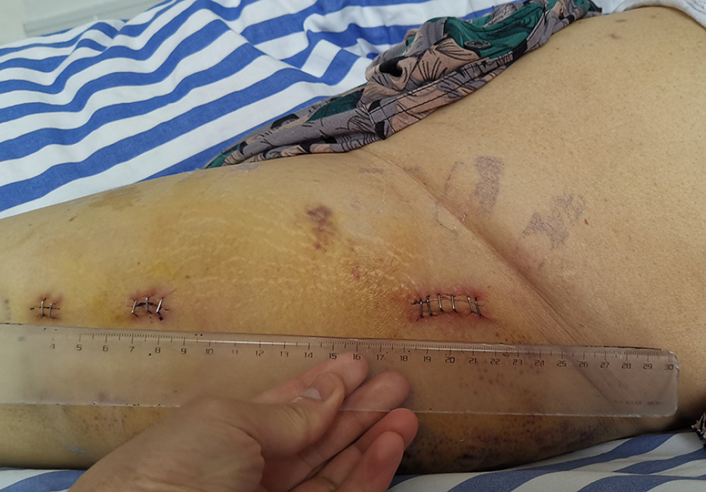 The anterolateral thigh incision for PFNA internal fixation of an intertrochanteric femoral fracture. The incision at the apex of the femoral greater trochanter measures approximately 3 cm in length, while the incision for spiral blade insertion is approximately 1.5 cm long, and the incision for distal locking screw placement is about 1 cm in length.