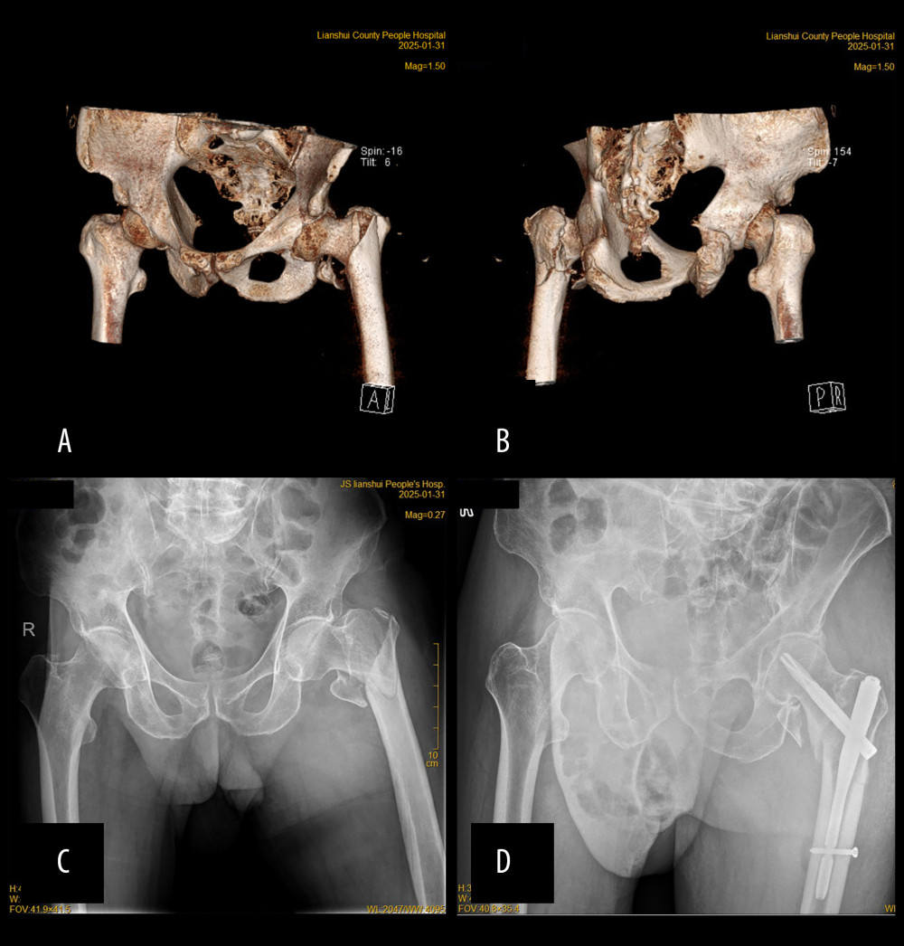Preoperative and postoperative figure images of an intertrochanteric femoral fracture with comminuted greater trochanter treated with PFNA fixation. (A, B) Preoperative three-dimensional CT imaging; (C) Preoperative X-ray imaging; (D) Postoperative X-ray imaging.