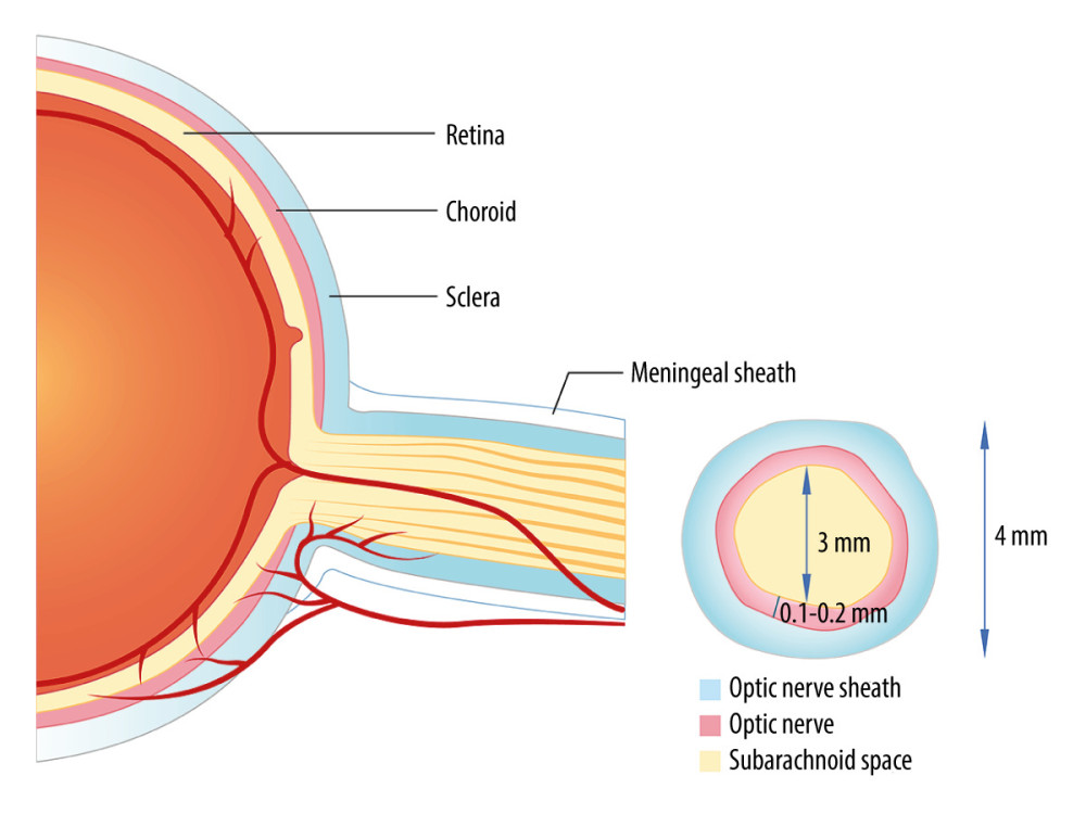 Transverse section of optic nerve sheath.