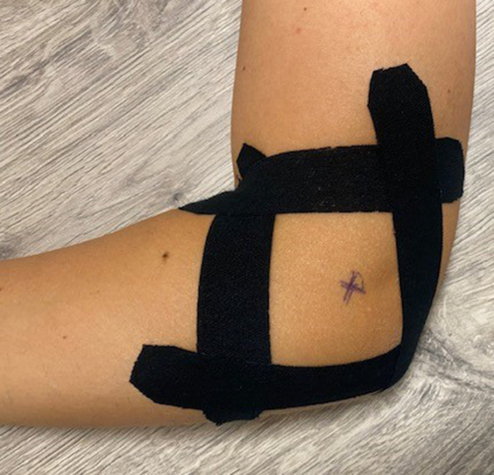The diamond taping method as the kinesio tape application method. In this technique, the tapes were placed in a diamond shape from distal to proximal, while simultaneously applying a perpendicular traction force to the soft tissues towards the lateral epicondyle.