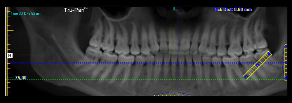 Placement of the vertical marker parallel to the long axis of the tooth. (I-CAT, Imaging Sciences Int, Hatfield, PA, USA).