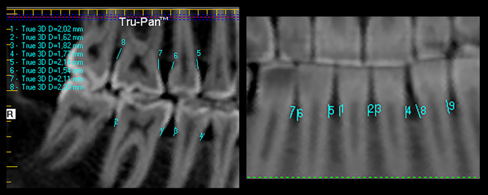 Measurement of the cemento-enamel junction-to-alveolar crest distance in the posterior and anterior regions. (I-(I-CAT, Imaging Sciences Int, Hatfield, PA, USA).