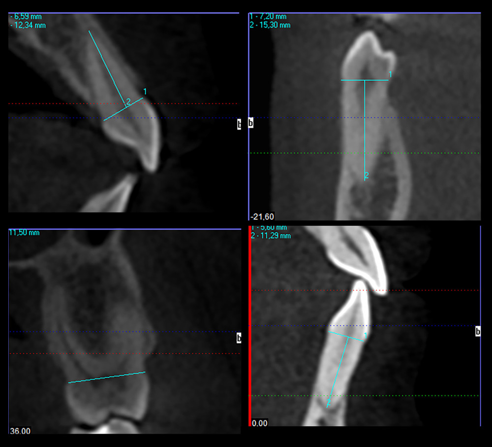 Buccolingual width measurements in different teeth. (I-CAT, Imaging Sciences Int, Hatfield, PA, USA).