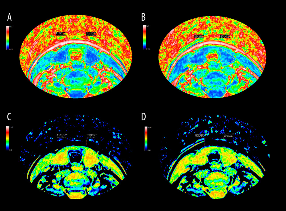 Fat-only (A, B) and water-only (C, D) images were generated through computational analysis. Images A and C depict the thyroid before dietary management, while images B and D illustrate the thyroid after 6 months of dietary management. The images and associated data demonstrate that, in patients with Hashimoto’s thyroiditis, there was a reduction in thyroid water fraction (C, D), along with decreased inflammation, following 6 months of dietary management. Additionally, statistical results indicate an increase in thyroid fat fraction (A, B). This figure was edited using Adobe Photoshop 2022 (version 23.0.0; Adobe Systems Incorporated).
