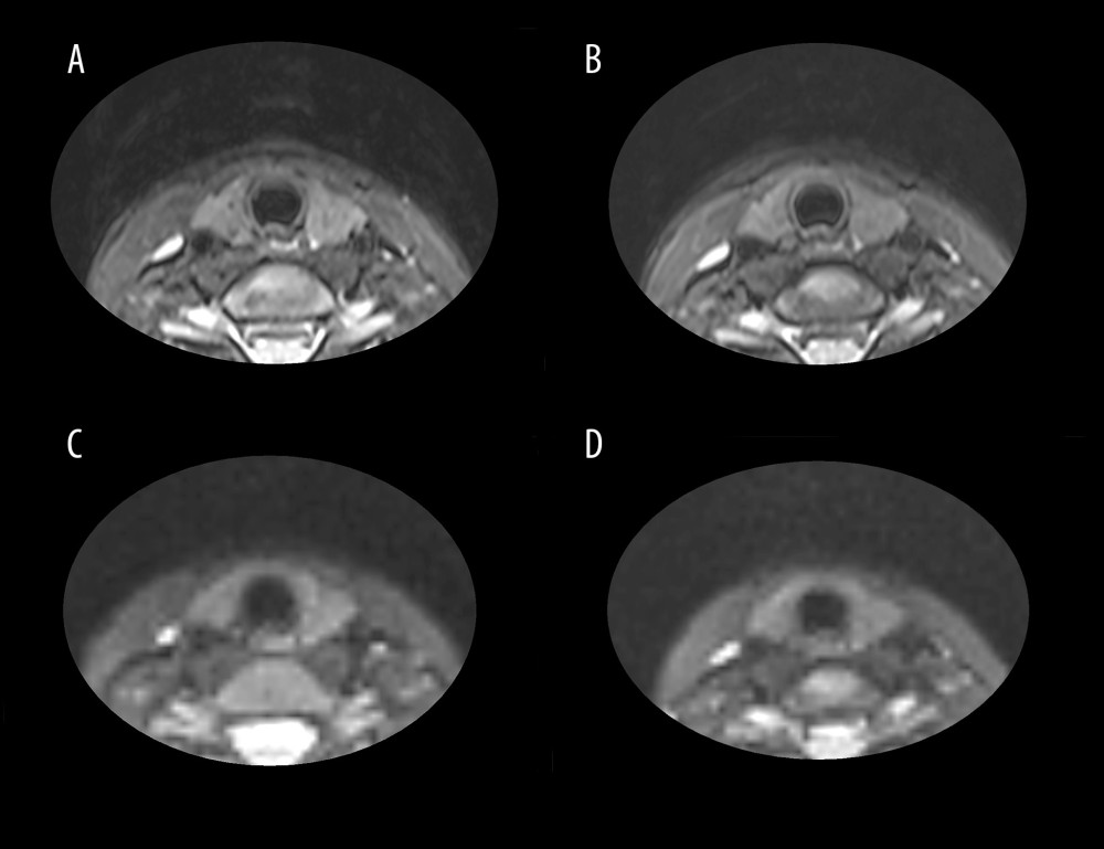 The figure above shows T2WI Dixon (A, B) and DWI (C, D) images from a representative patient. Images A and C demonstrate thyroid morphology prior to dietary intervention, while images B and D show the corresponding changes after 6 months of dietary management. All images were processed using Adobe Photoshop 2022 (version 23.0.0; Adobe Systems Incorporated).