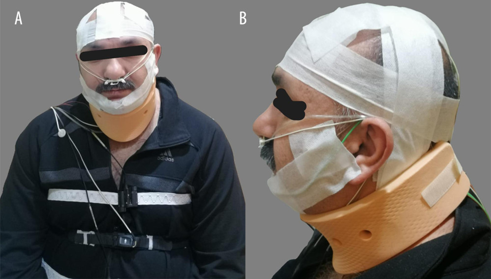 (A) Application of the soft cervical collar during polysomnography. This figure demonstrates the application of the Case-Nelson Soft Cervical Collar in a patient undergoing overnight polysomnography (PSG). The cervical collar is designed to provide anterior airway support, reducing excessive neck flexion and minimizing upper airway collapse during sleep. Standard PSG monitoring electrodes, nasal cannula, and respiratory effort belts are also visible, ensuring comprehensive data collection on sleep parameters. (B) Lateral view of the soft cervical collar in place. A lateral view of the Case-Nelson Soft Cervical Collar is presented, illustrating its adjustable fit and positioning around the neck. The collar maintains a neutral head position, preventing posterior airway collapse, which is hypothesized to reduce apnea-hypopnea events in patients with obstructive sleep apnea (OSA). PSG monitoring equipment, including nasal airflow sensors and EEG electrodes, is also visible.