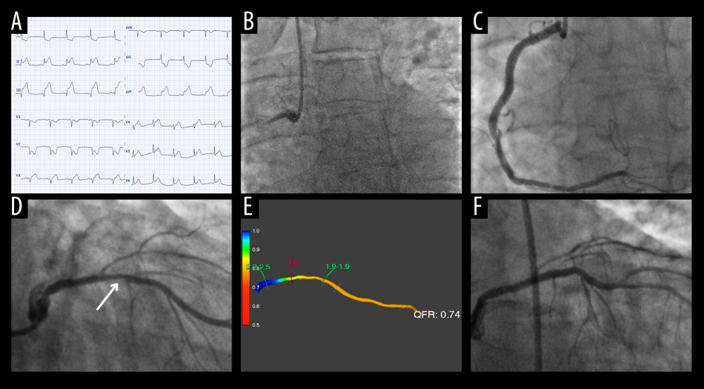 Patient selection into this study with a case example. Figure represents a case from our study of a 72-year-old man who was admitted to our center with acute chest pain. Electrocardiography confirmed an inferior ST-elevation myocardial infarction (A). Coronary angiography revealed a total occlusion of the right coronary artery (B), and the patient underwent an index culprit lesion percutaneous coronary intervention (PCI) to restore blood flow in the occluded artery (C). Coronary angiography also identified an approximately 75% stenosis in the left anterior descending artery (LAD) (white arrowhead) (D). A quantitative flow ratio of the LAD was performed, yielding a result of 0.74, indicating that the stenosis was hemodynamically significant (E). The LAD was treated during a staged procedure 3 months after the index PCI (F).