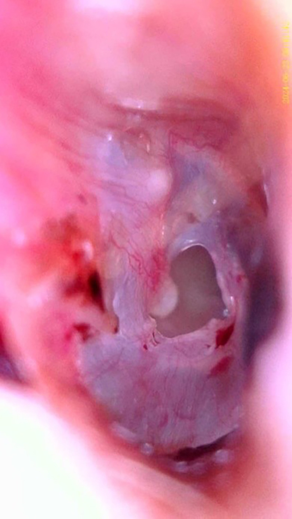 A typical C-shaped central perforation of the tympanic membrane, similar to a “kidney bean” shape but ripped fragment of the tip of the malleus handle wrapped in the tympanic membrane, including on the inner side. A cholesteatoma formed in the area of the auricle. The lower edge of the perforation is smooth, thickened, with possible downward wrapping of membrane fragments.