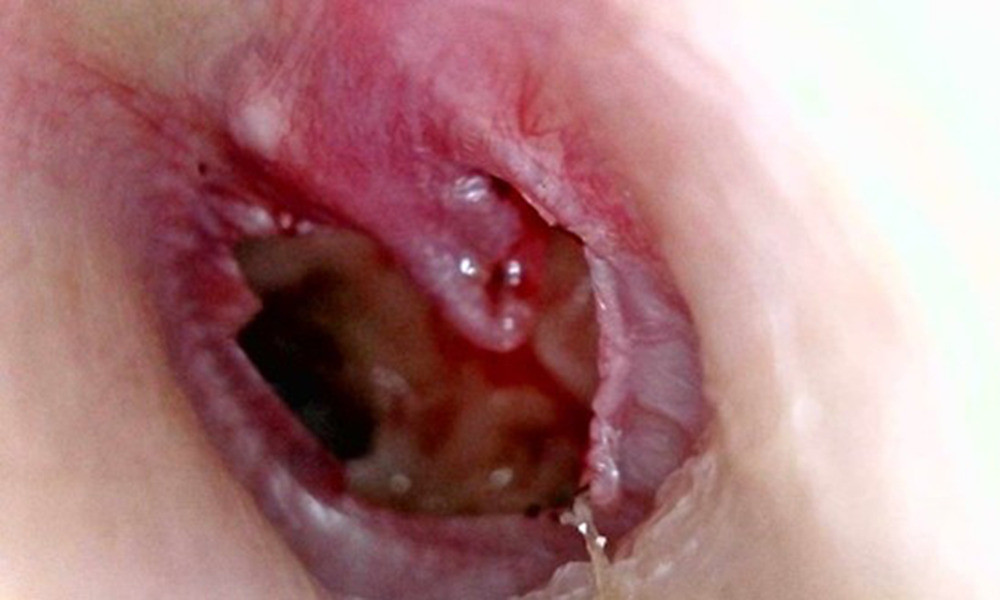 Post-explosive perforation of the tympanic membrane on the first day after injury. Perforation involves all quadrants. The remaining tympanic membrane was hemorrhaged. Fragments of tympanic membrane are wrapped around the handle of the malleus.