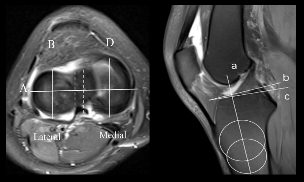 In this image, magnetic resonance images of the knee joint are axial and sagittal. B and D are the medial and lateral tibial plateau midline in the sagittal plane, respectively. A is the medial and lateral plateau midline in the coronal plane. a is the tibial axis, b is the vertical line of a, c is the tangent line of the tibial plateau, and the angle between b and c represents the posterior tibial slope angle.