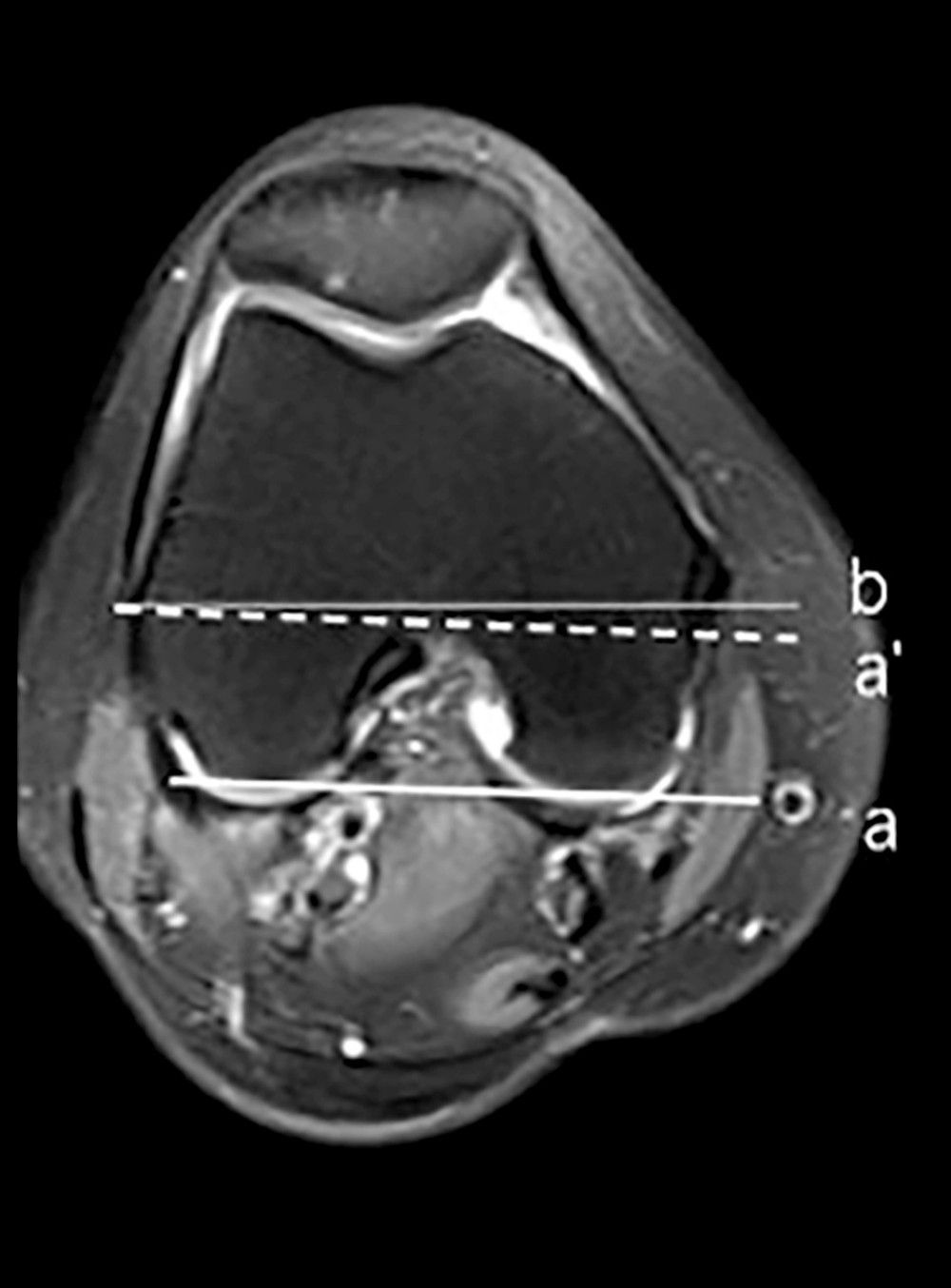 a is the tangent line of the posterior condyle on the magnetic resonance axial image of the knee joint, a′ is its parallel line, and b is the line of the internal and external epicondyle of the knee joint, representing the central axis of the knee joint movement. The angle between a′ and b is the rotation angle of the knee joint.