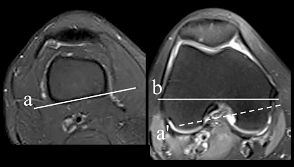 This measurement method was described by Yang et al [18]. a is the posterior tangent line of the distal shaft of the femoral shaft, a′ is its horizontal line, b is the transepicondylar axis, and the angle between the posterior tangent of the distal femoral shaft and the transepicondylar axis (PTFS-TEA) is defined as the angle between a′ and b.