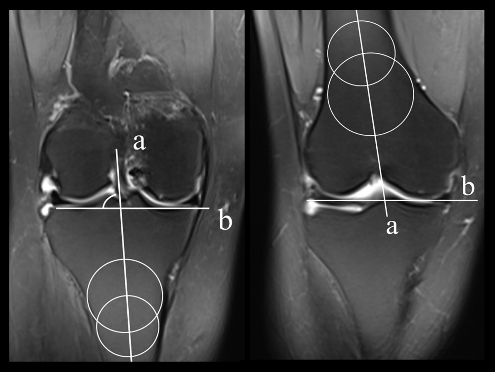 In this figure, the axis of the femur or tibia is represented. b is the tangent line of the tibial plateau or distal femur, and the angle of inversion or valvaration of the femur or tibia is measured by the angle between the 2 lines.