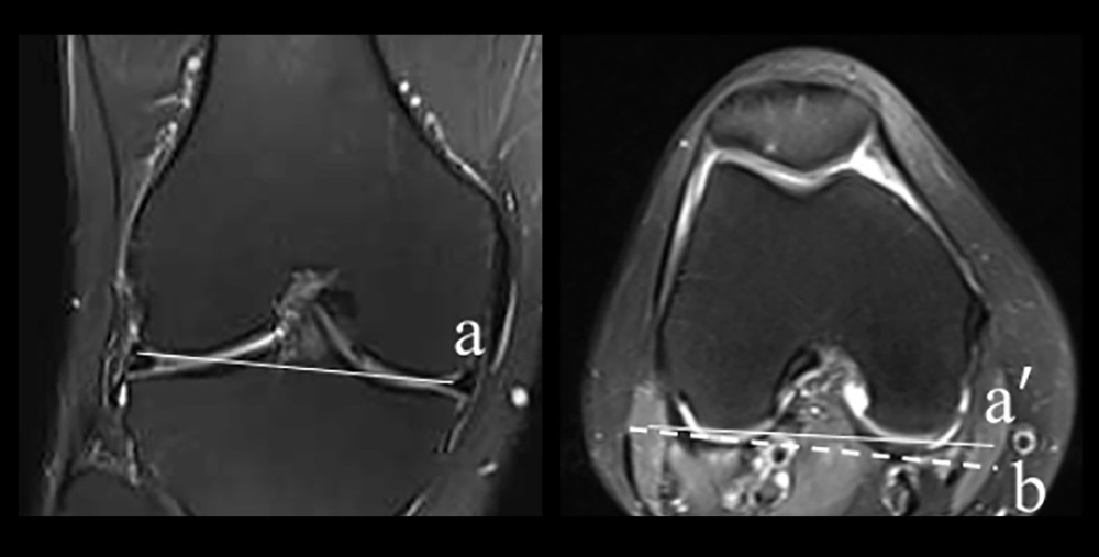 a is the tangent line of the distal femur, b is the horizontal line of a, and a′ is the tangent line of the posterior condyle of the femur. The distal condylar angle (DCA) is defined as the angle between the 2 lines.