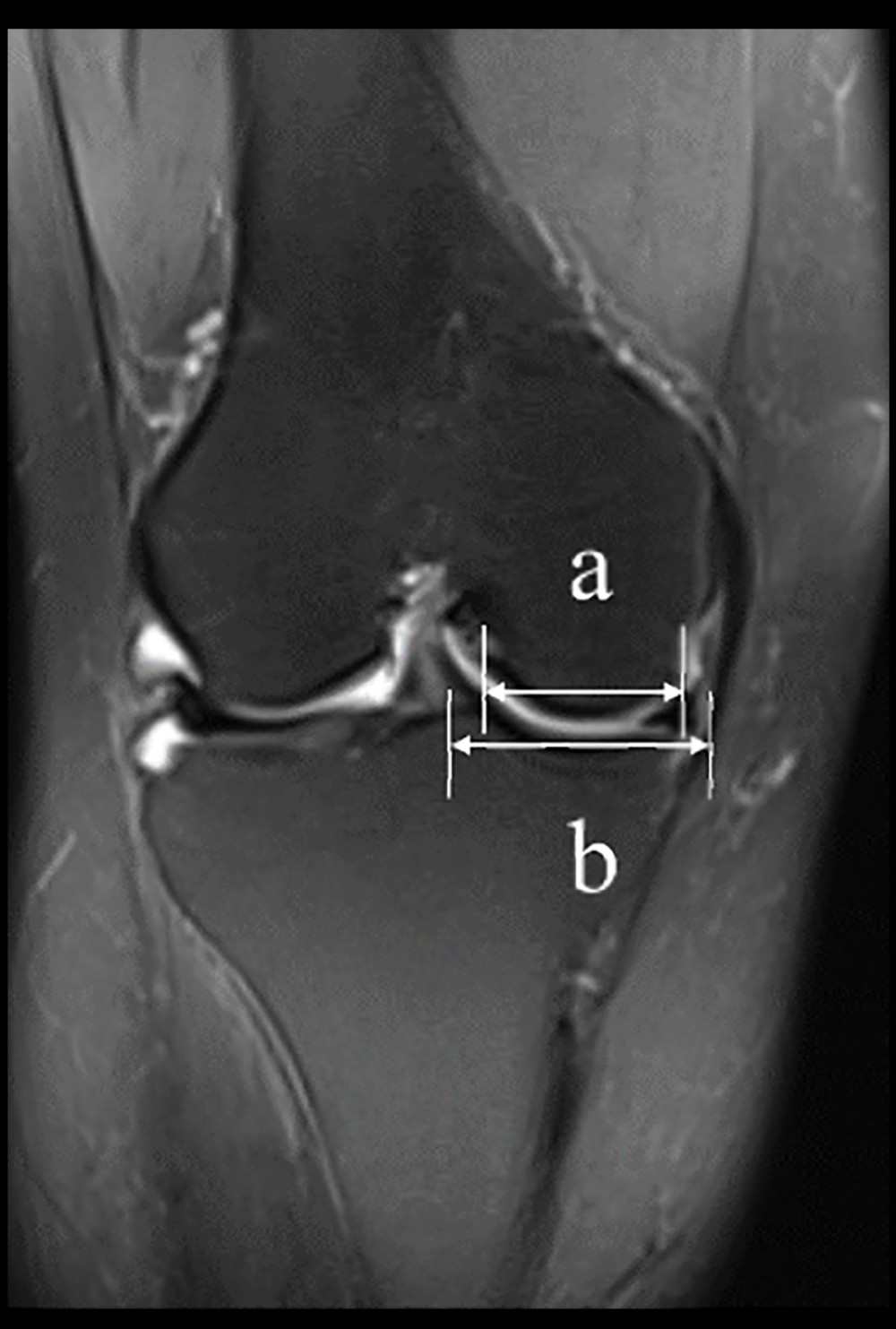 a and b represent the width of the medial and lateral condyles of the femur, respectively.