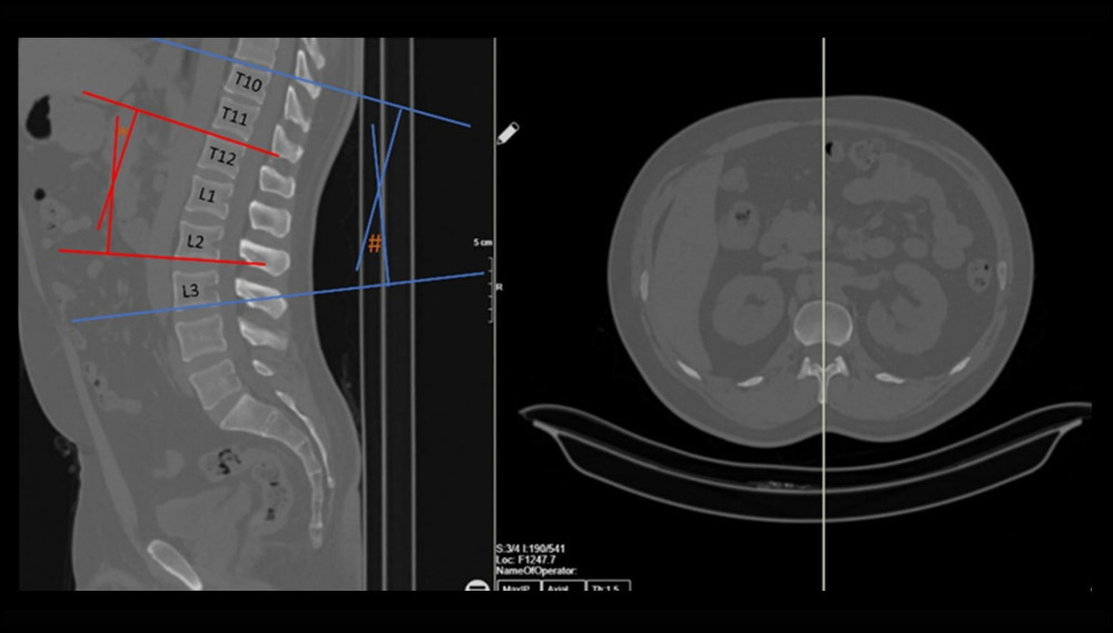 The measurements made in the study are shown. After confirming that the spinous process was centered in the axial plane, measurements were made in the sagittal plane. The measurements shown with red lines are the segmental Cobb angle measurement of the L1 vertebra (*). The measurements made with blue lines are the global Cobb angle measurement between T11 and L2 (#).