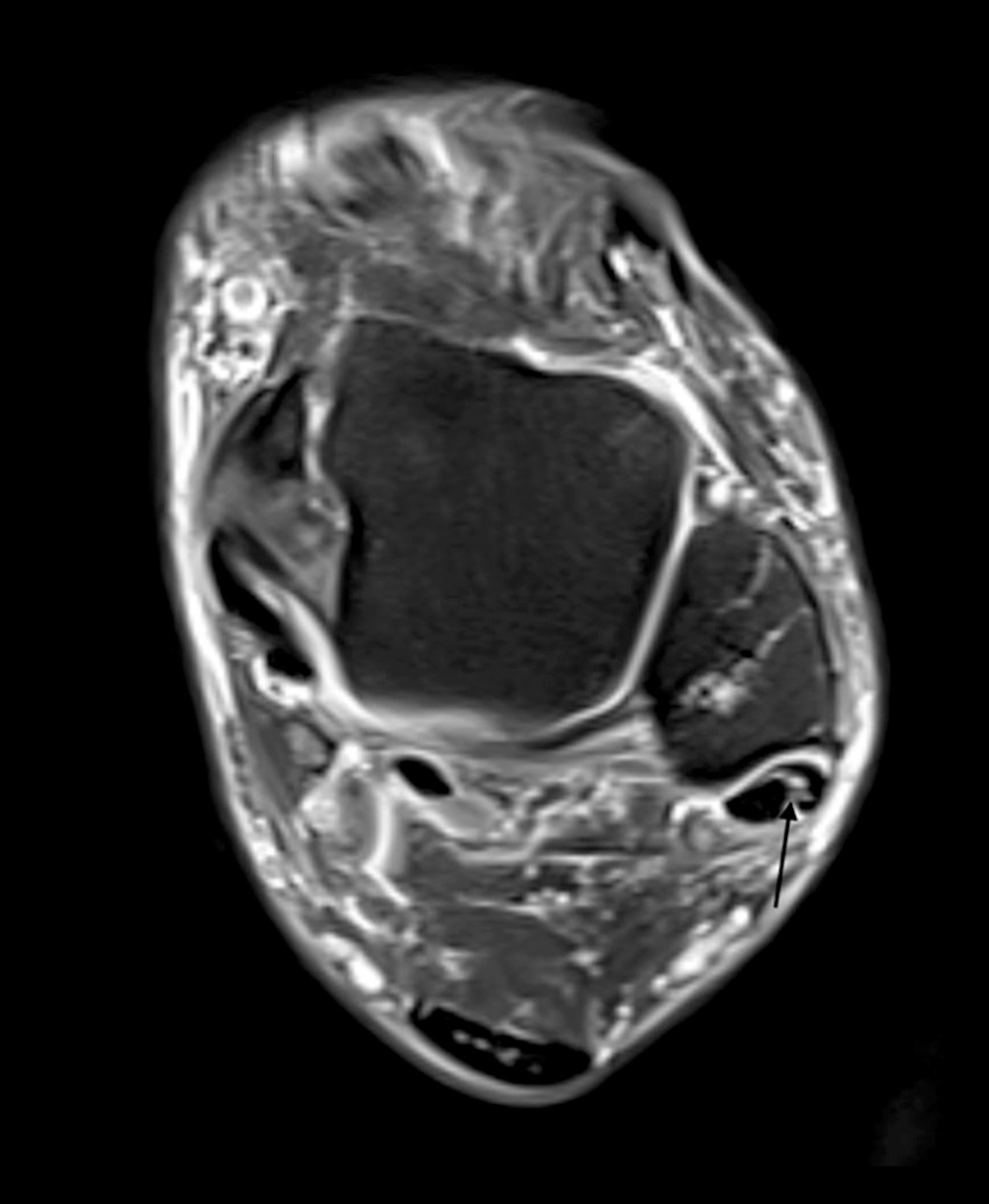 An axial magnetic resonance image that shows a partial tear of the peroneus brevis tendon (PBT), which is marked with the black arrow. The magnetic resonance imaging (MRI) data was obtained from a Picture Archiving and Communication System (PACS) and then exported to the RadiAnt DICOM Viewer (version 2021.2; Medixant) for analysis.