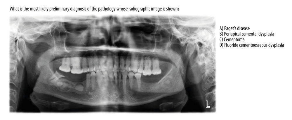 ChatGPT 4.0, Grok 2, and Blackbox 3 AI chatbots gave correct answers to the fluoride cemento-osseous dysplasia case.