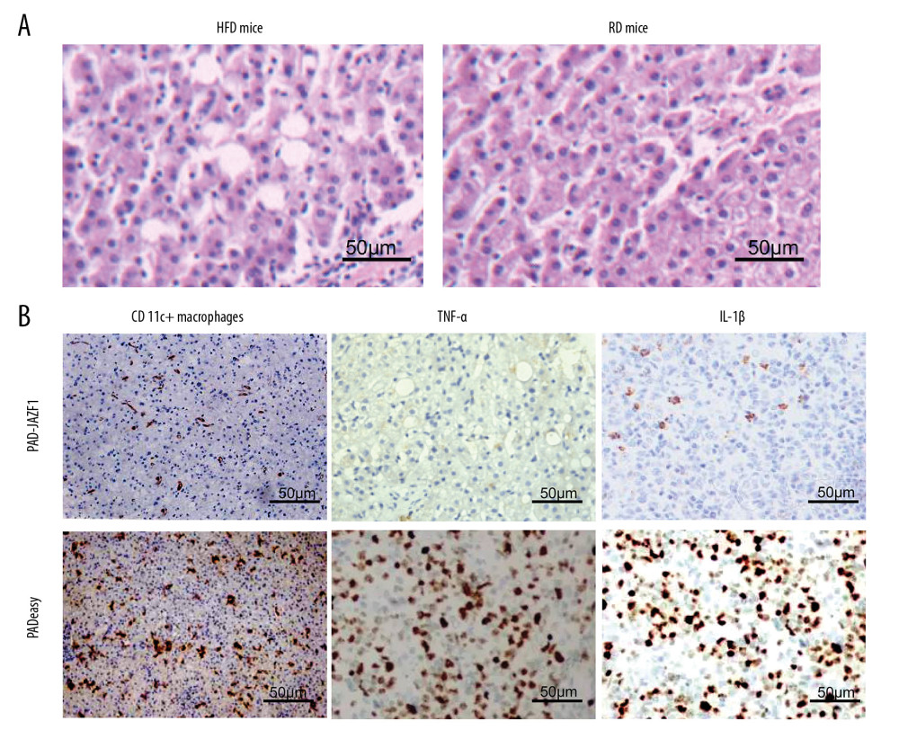 CD11c+ macrophages and TNF-α and IL-1β expression levels in the liver. (A) HE staining results for the liver of high-fat diet (HFD)-fed mice and regular diet (RD)-fed mice. (B) IHC staining results for CD11c+ macrophages and TNF-α and IL-1β levels in the livers of the PAD-JAZF1 group and pAdEasy control group.