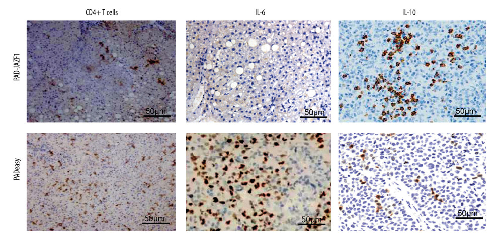 IHC analysis of CD4+ T cells and IL-6 and IL-10 expression levels in the livers of the PAD-JAZF1 and pAdEasy control groups.