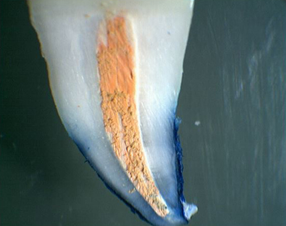 Apical dye leakage after the step-back technique and obturation with AH Plus and lateral gutta-percha compaction.