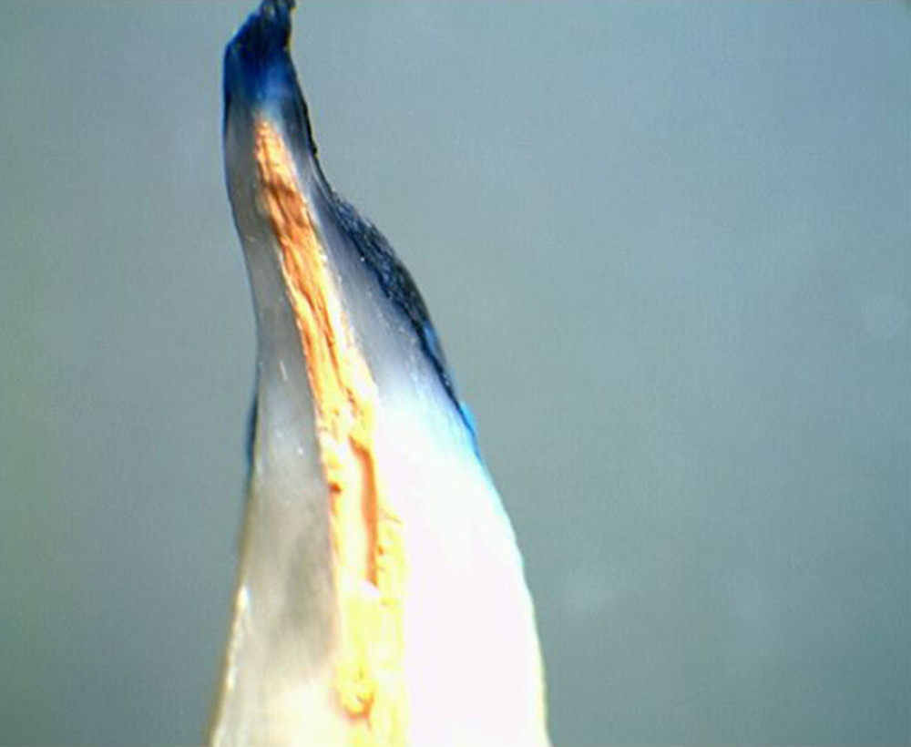 Apical dye leakage after the step-back technique and filling with Apexit Plus and lateral gutta-percha compaction.