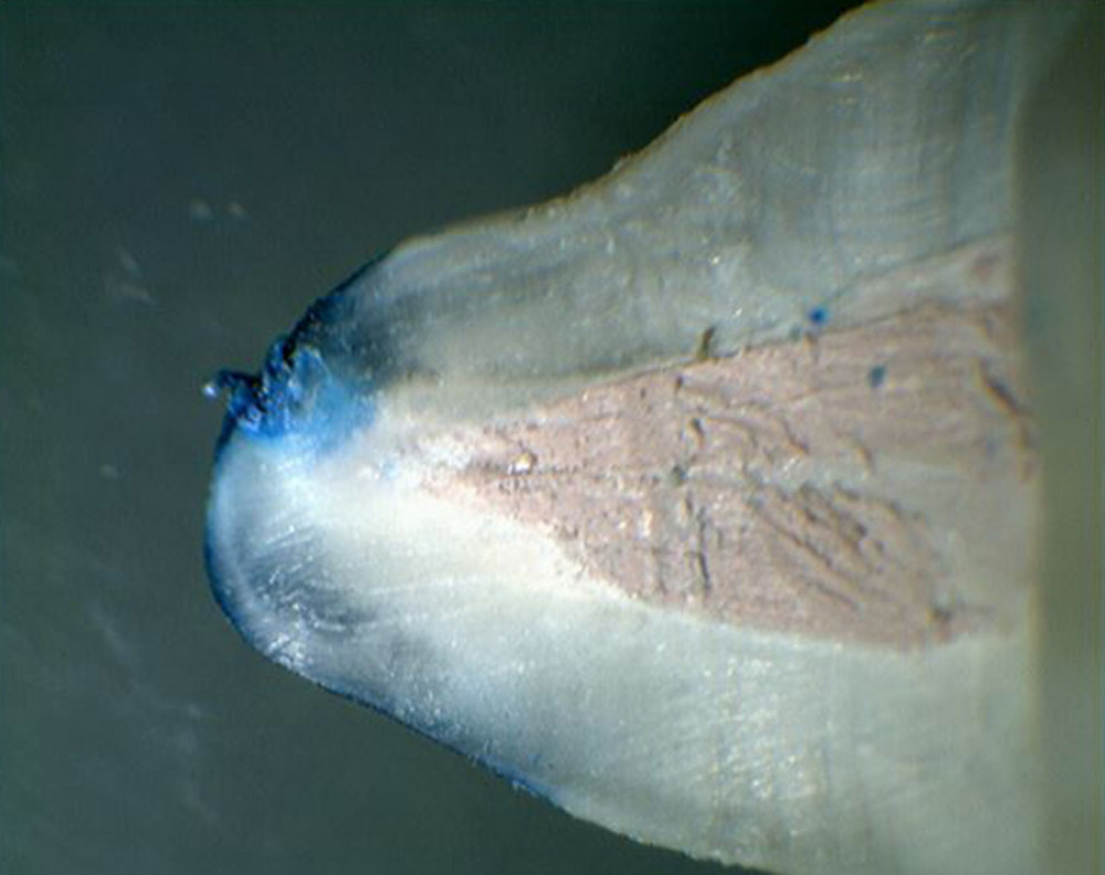Apical dye leakage after the step-back technique and filling with Resilon/Epiphany system.