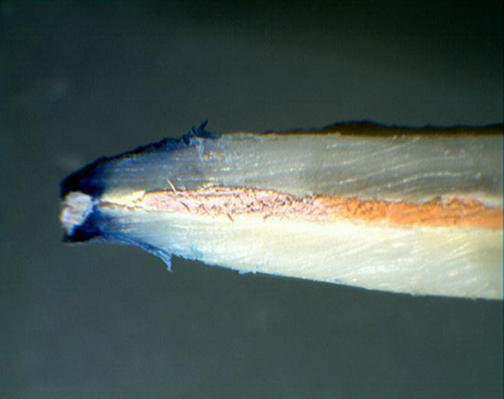 Apical dye leakage after the crown-down preparation technique and filling with AH Plus and Thermafil obturator.