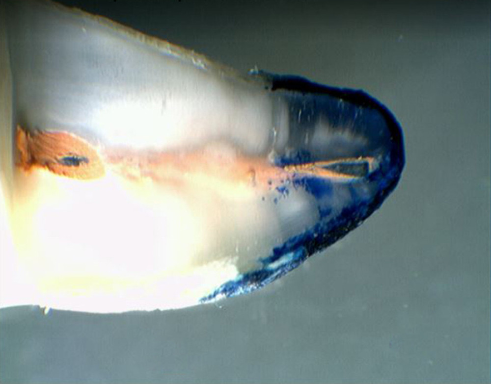 Apical dye leakage after the crown-down preparation technique and filling with Apexit Plus and Thermafil obturator.