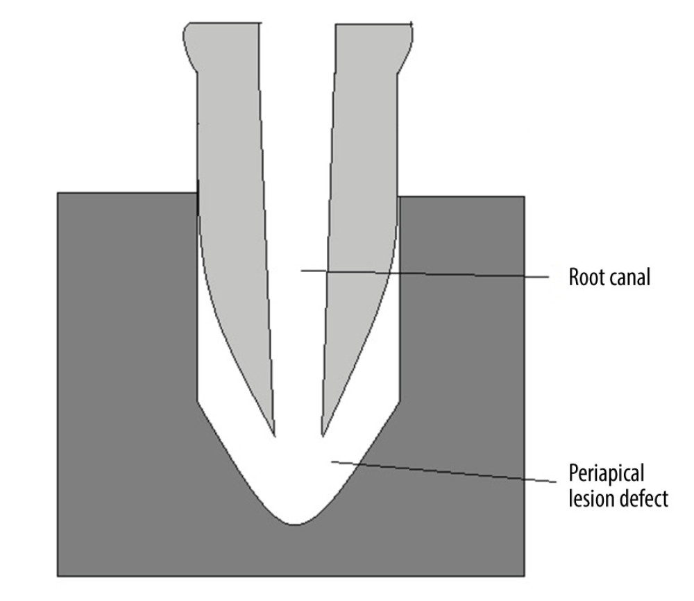 Schematic presentation of an in vitro artificial model of periapical lesion defect under a single root canal.