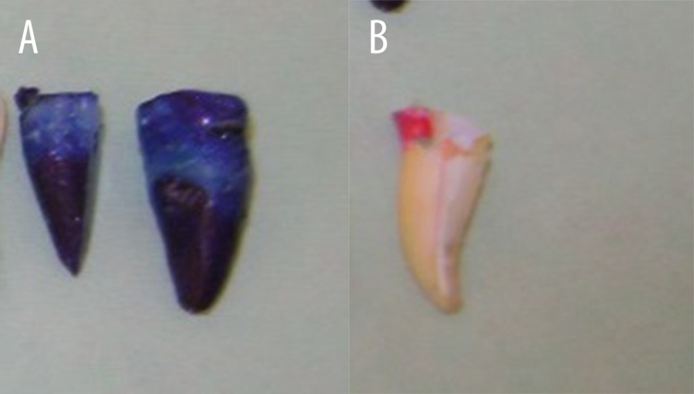 (A) Dye leakage in positive control group. (B) Apical dye leakage in negative control group.