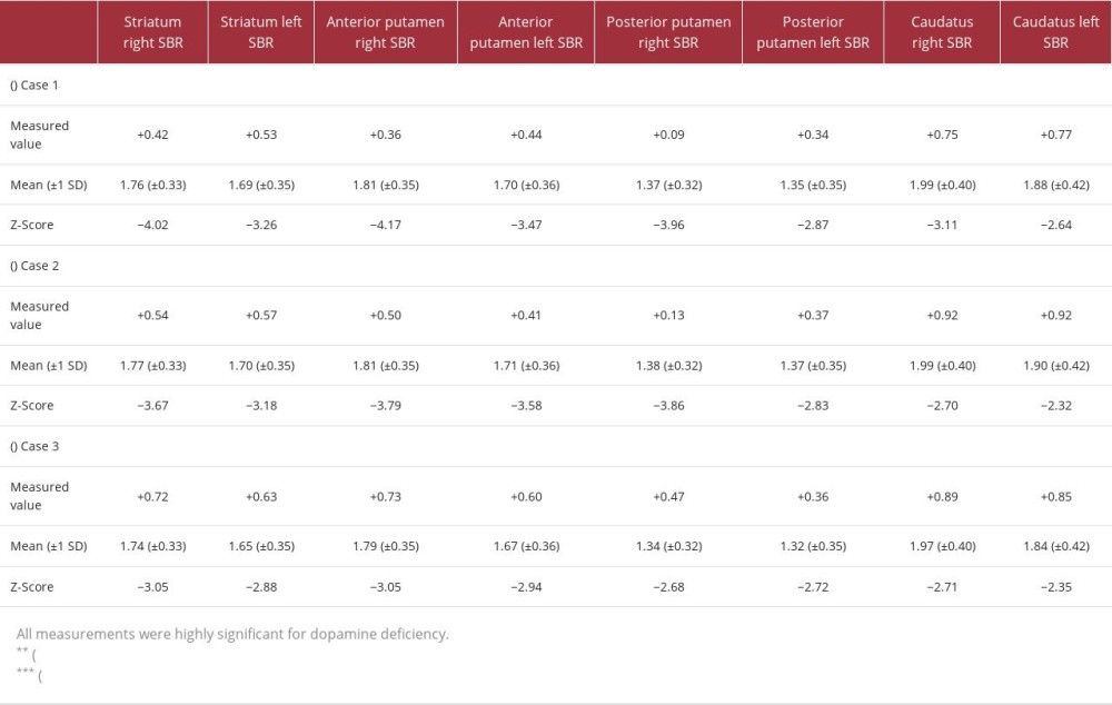 DAT scan-measured values compared with age-specific mean values, followed by the Z-Score for (A) Case 1, (B) Case 2, and (C) Case 3, respectively.