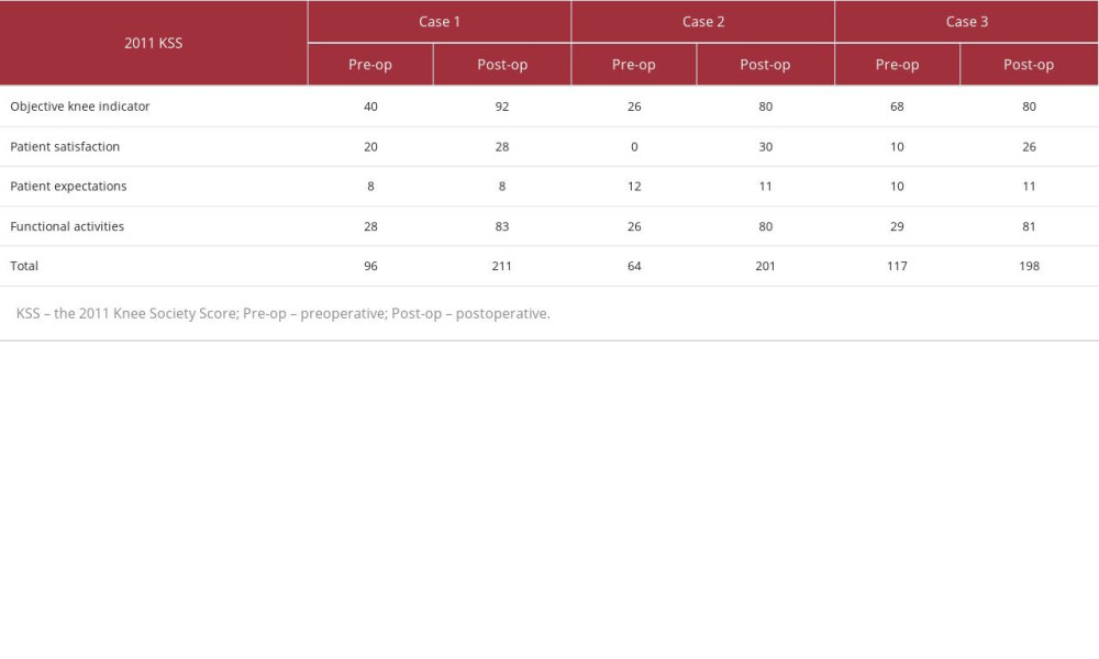 Pre- and post-surgery knee scores: three cases.This table shows the preoperative and postoperative 2011 Knee Society Scores for 3 cases, arranged in the order of objective knee indicator, patient satisfaction, patient expectations, functional activities, and total.