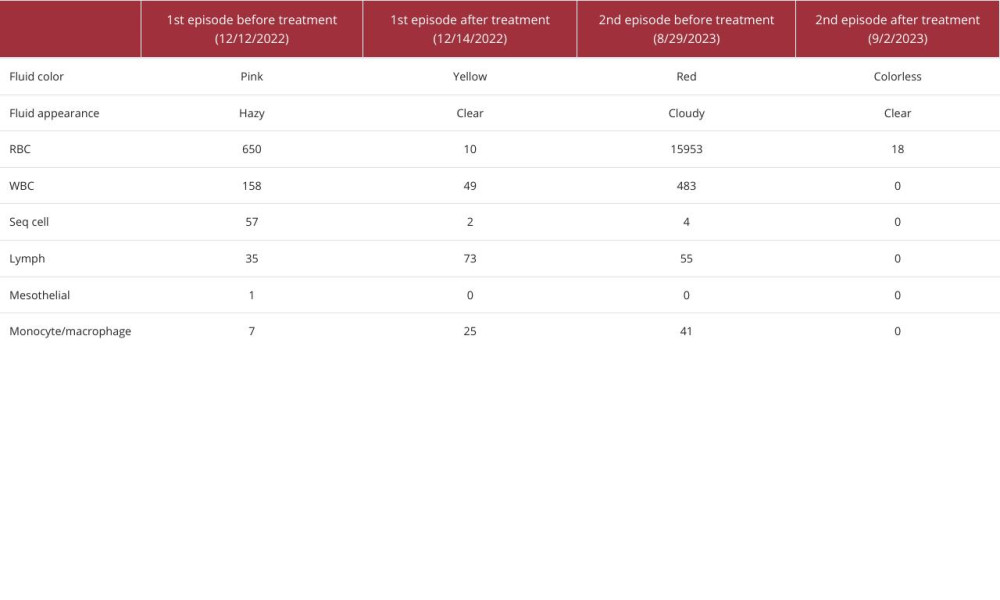 Peritoneal dialysis fluid analysis results from our patient.